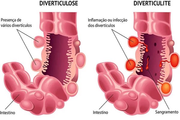 Diverticulose E Diverticulite Dr Kássio 0296